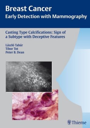 Casting Type Calcifications: Sign of a Subtype with Deceptive Features